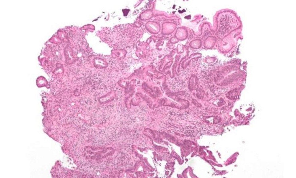 
Adenocarcinoma invasivo, o tipo mais comum de cancro colorretal (foto: Nephron/Wikimedia Commons)
