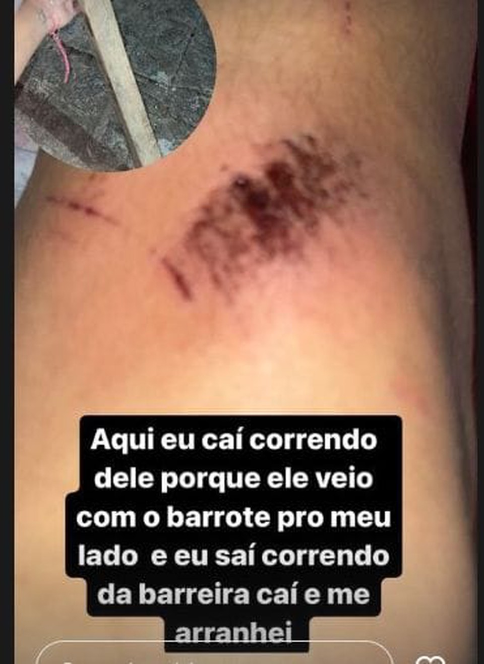 A vtima publicou fotos em suas redes sociais mostrando os ferimentos provocados pelas agresses  (Foto: Reproduo/Redes Sociais )