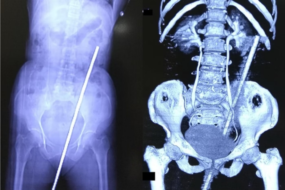 Raio x de uma mulher que ficou empalada em ferro de 60 cm aps cair no cho do quintal (Crdito: International Journal of Surgery Case Reports)