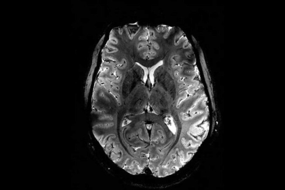 
A ressonncia permite visualizar alteraes no padro da conexo entre clulas e redes cerebrais (foto: CEA/Divulgao)