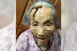 Mulher de 107 anos tem chifre de 10 cm na testa (Crdito: Freepik)