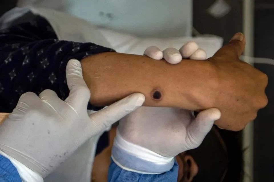 As leses do corpo causam dores e coceira e algumas manchas podem deixar cicatrizes (foto: Ernesto BENAVIDES / AFP)