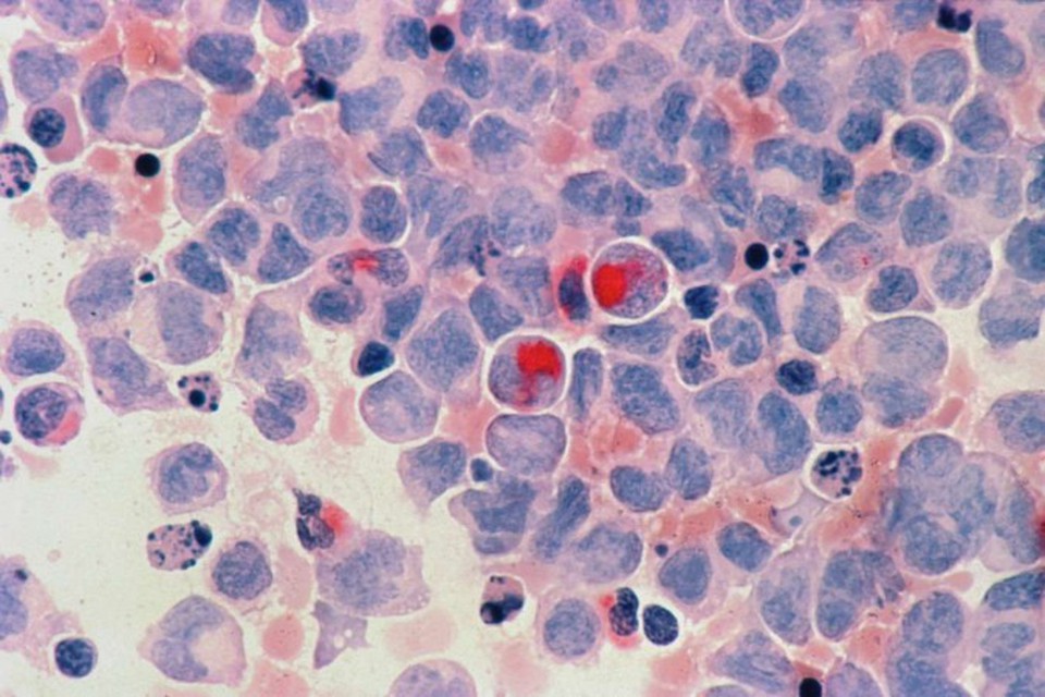 
O tumor afeta os glbulos brancos do sangue, responsveis por defender o corpo contra organismos infecciosos e substncias estranhas  (foto: National Cancer Institute/Unsplash)