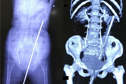 Idosa cai no pasto e fica empalada em ferro de 60 cm na ndia (Crdito: International Journal of Surgery Case Reports)