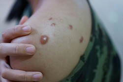 A mpox  causada pelo mpox vrus (MPXV), do gnero Orthopoxvirus e famlia Poxviridae