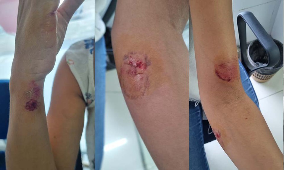 A mulher foi atacada pelo ex-companheiro com golpes de faca e ainda foi lesionada com mordidas, em seu apartamento, no bairro de Candeias, em Jaboato dos Guararapes  (Foto: Reproduo/Redes Sociais )