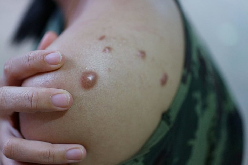 A mpox  causada pelo mpox vrus (MPXV), do gnero Orthopoxvirus e famlia Poxviridae (Foto: AFP)