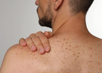 2 ingredientes super fáceis que tiram manchas da pele