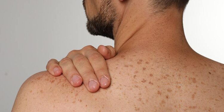 2 ingredientes super fáceis que tiram manchas da pele