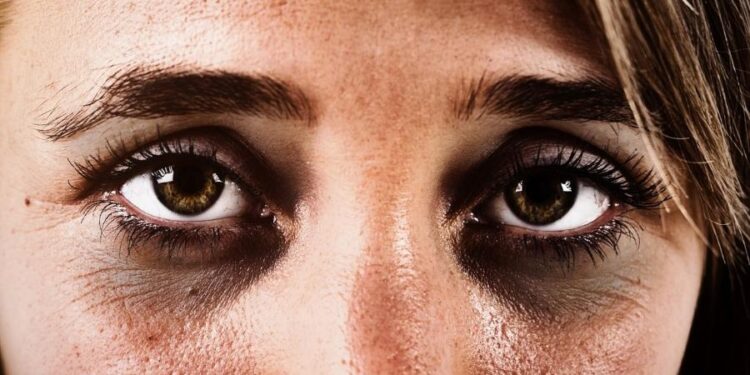 Creme caseiro e fácil de fazer acaba ligeirinho com olheiras