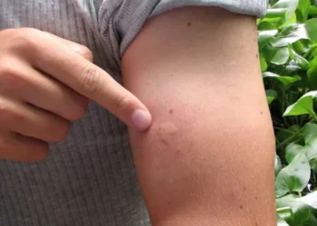 Revelada a melhor forma para combater picadas de insetos