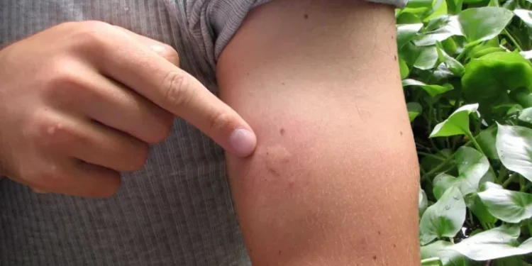 Revelada a melhor forma para combater picadas de insetos