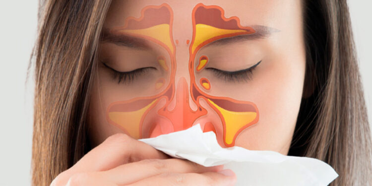 Revelado quais os remédios que realmente funcionam para rinite