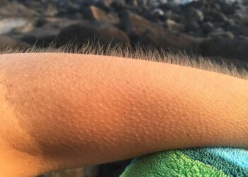 O que são aqueles arrepios estranhos que sentimos na cabeça?