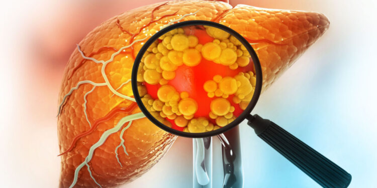 Notícia assustadora sobre gordura no fígado acabou de ser divulgada