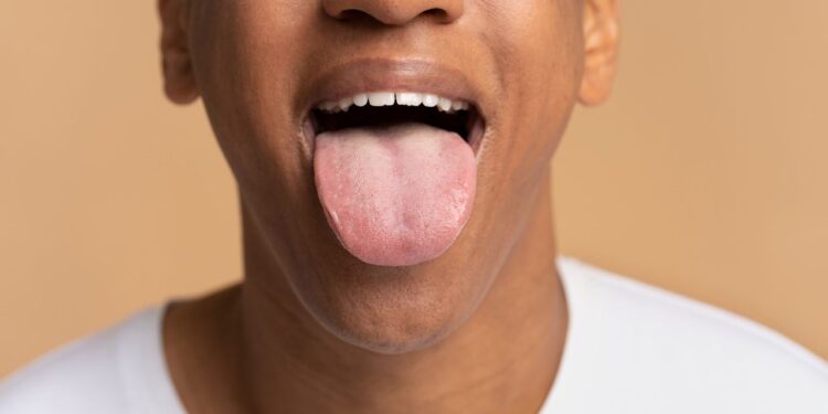 Língua na cor branca significa mau cuidado? Entenda como solucionar